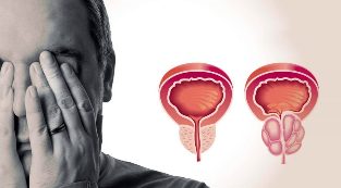Healthy and inflamed prostate