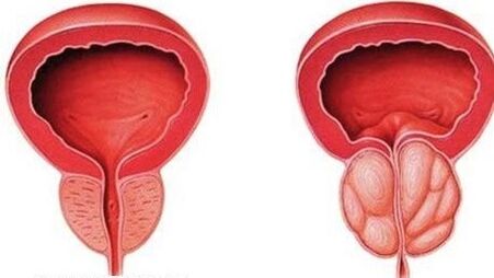 normal and swollen prostate