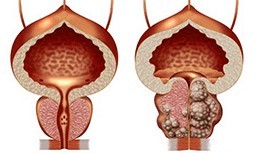 Healthy and of the waste of the prostate
