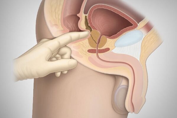 Prostate massage for bacterial prostatitis. 