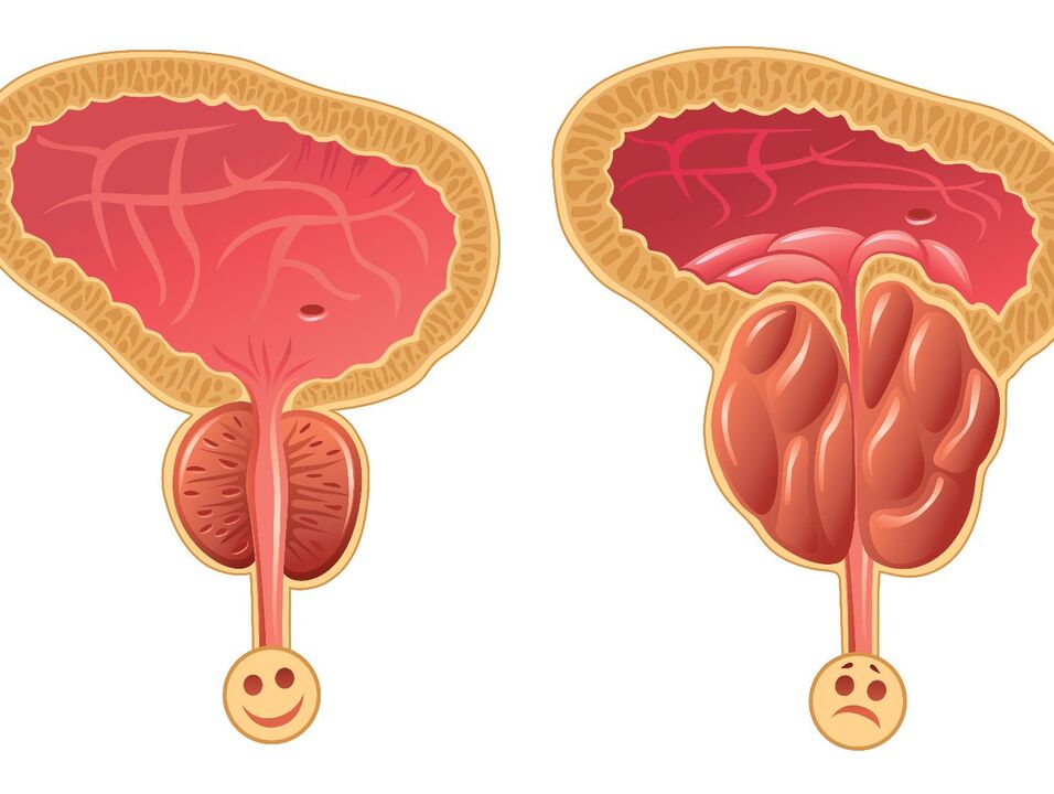 Healthy prostate and prostate congestion with congestive prostatitis