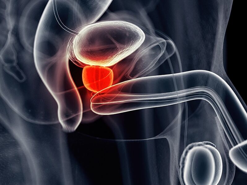 Inflammation of the prostate that accompanies chronic prostatitis.